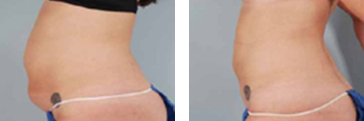 Bauch vor und nach der Injektions-Lipolysebehandlung
